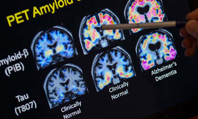Medical PET images of six brains showing beta-amyloid and tau plaque, with a pen pointing to one of the images