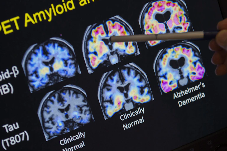 Medical PET images of six brains showing beta-amyloid and tau plaque, with a pen pointing to one of the images