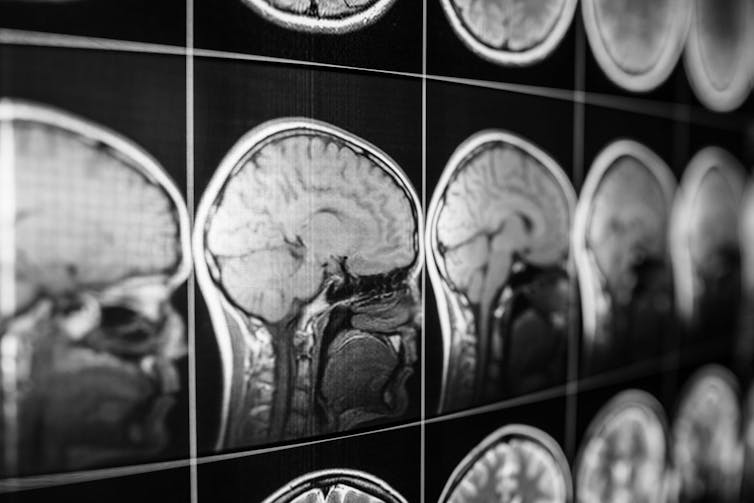Medical imaging of human brain