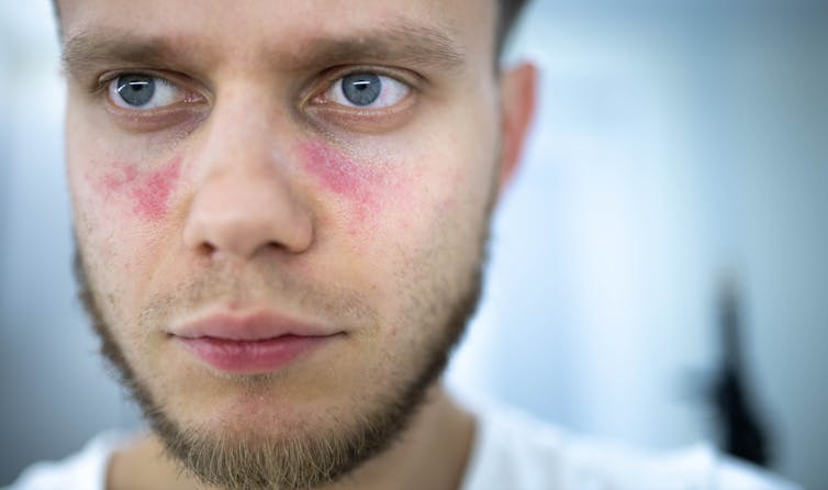 man with rash on face