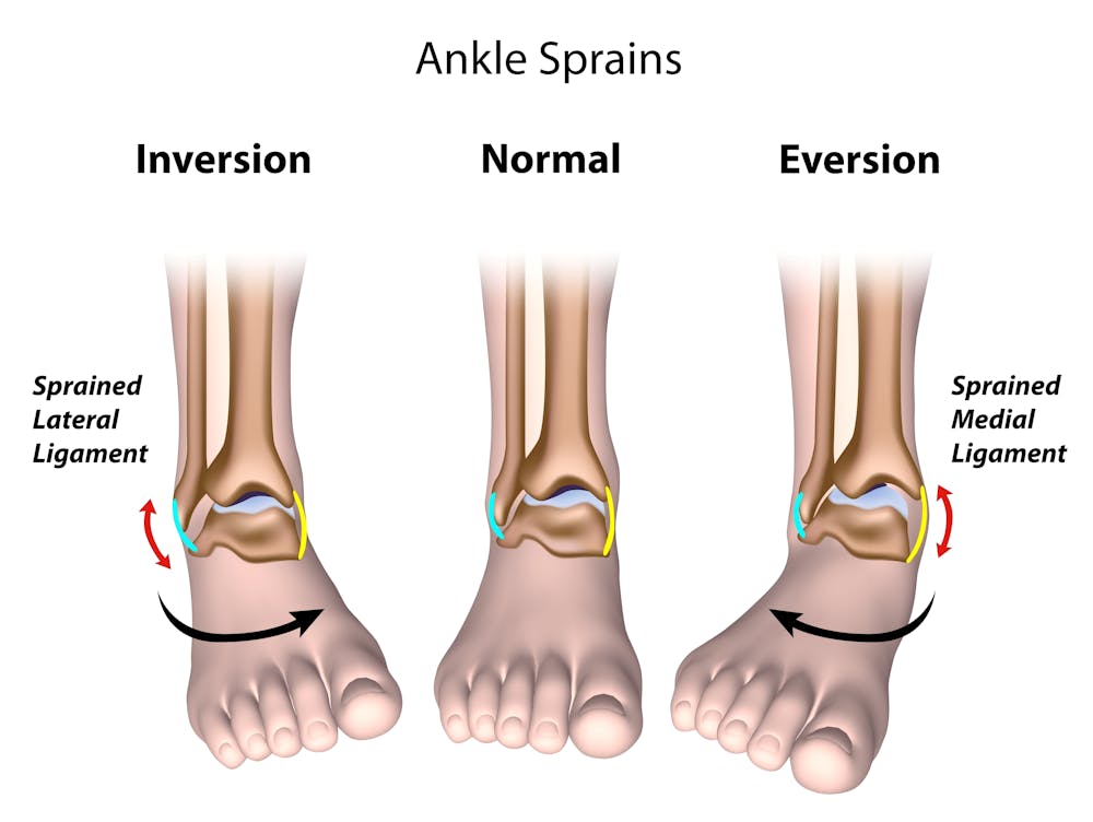 Two common types of ankle sprain (inversion and eversion) Stock Vector