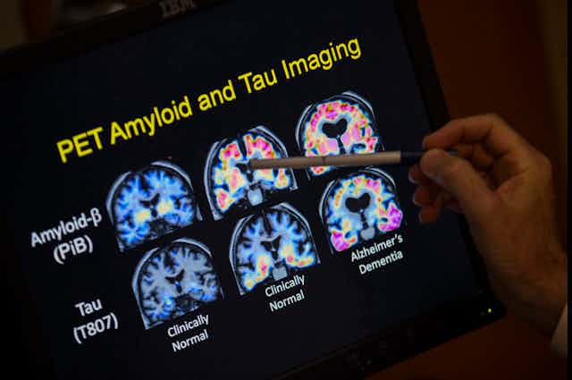 Images d'un cerveau atteint et non atteint de la maladie d'Alzheimer
