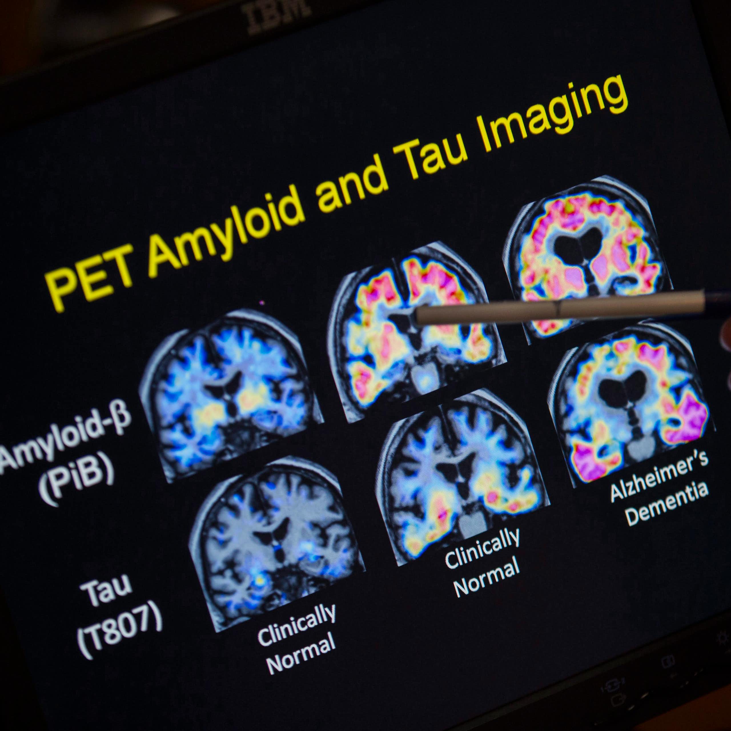Images d'un cerveau atteint et non atteint de la maladie d'Alzheimer