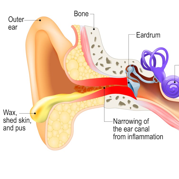 This illustration, depicting both the outer and inner ear, shows how the infection from swimmer's ear has narrowed the ear canal.