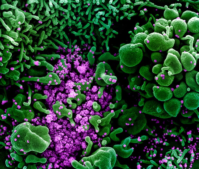 Micrographie électronique à balayage colorisée d'une cellule apoptotique - autrement dit, mourante - (en vert) fortement infectée par des particules virales du SARS-COV-2 (en violet).