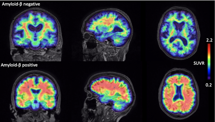 A brain scan image comparing a healthy brain with one that shows signs of beta-amyloid.
