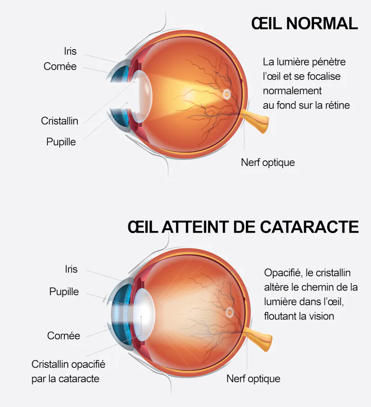 En cas de cataracte, la lumière se transmet de façon diffuse dans l’œil par rapport à un œil normal où elle est focalisée