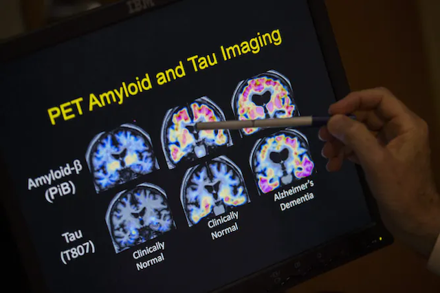 Gambar PET medis dari enam otak menunjukkan beta-amiloid dan plak, dengan pena yang menunjuk ke salah satu gambar