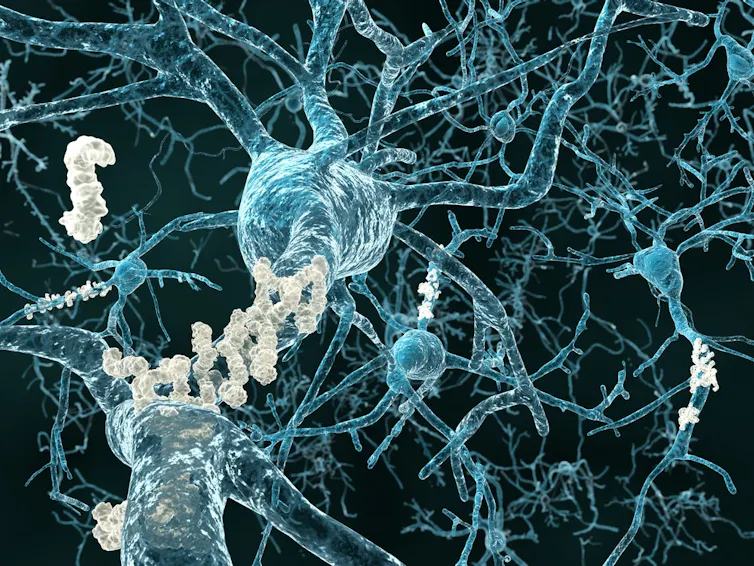 neurones avec plaques amyloïdes