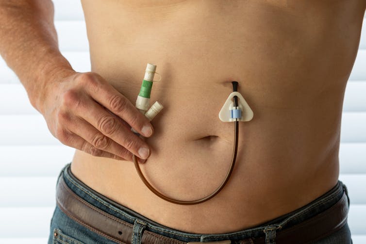 Parkinson's Disease patient displaying a surgically installed tube that delivers anti-Parkinson's medication directly into the jejunum