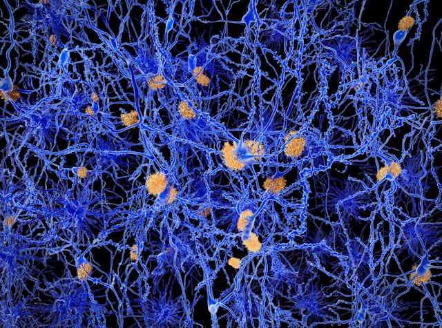 Amyloid plaques clumping on brain cells.