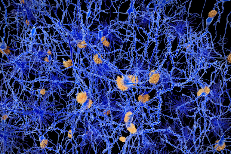 Amyloid plaques clumping on brain cells.