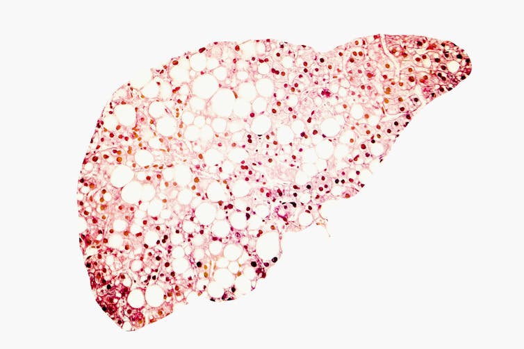 Illustration of fatty liver pathology