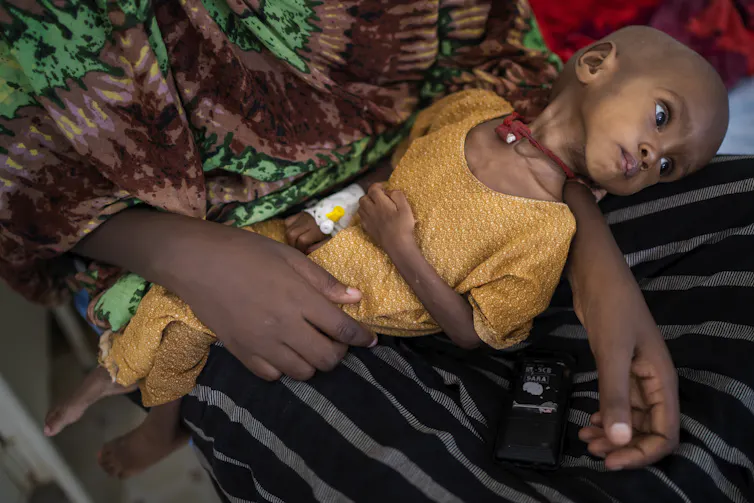A malnourished child held by her mother