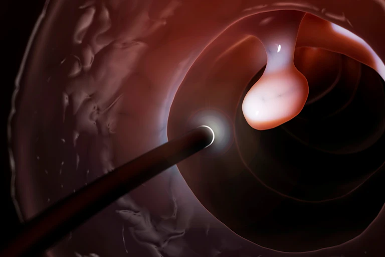An illustration that shows a snake-like probe finding a white, round-ish polyp inside a human colon.