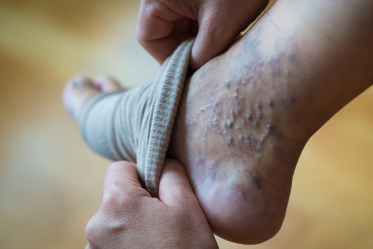 Person putting on compression stockings