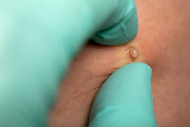 Close-up of gloved hand popping a pimple.