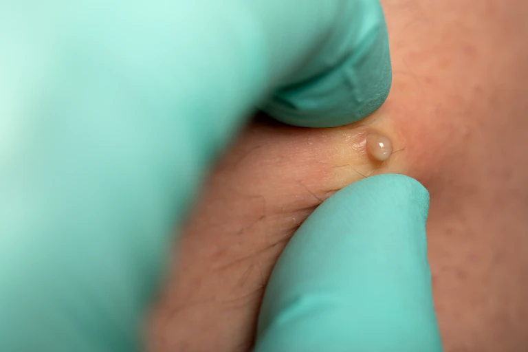 Close-up of gloved hand popping a pimple.