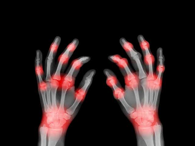 X-ray with joints highlighted in red