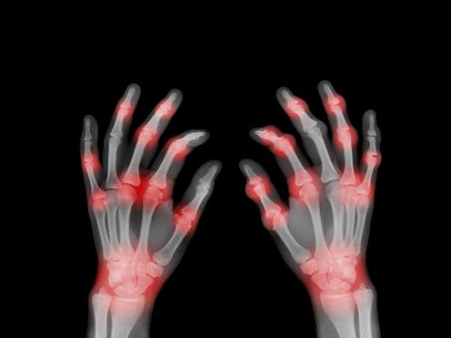 Newly discovered species of bacteria in the microbiome may be a culprit behind rheumatoid arthritis