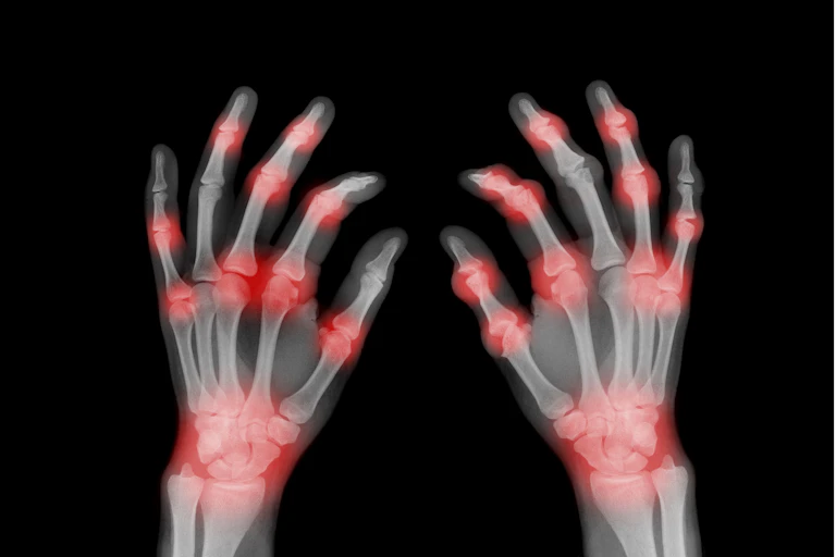 X-ray with joints highlighted in red