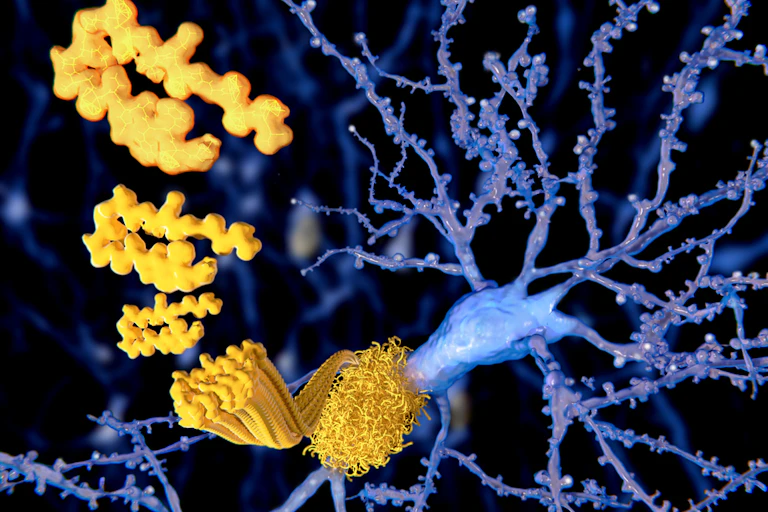 plaques amyloïdes agglutinées sur les neurones