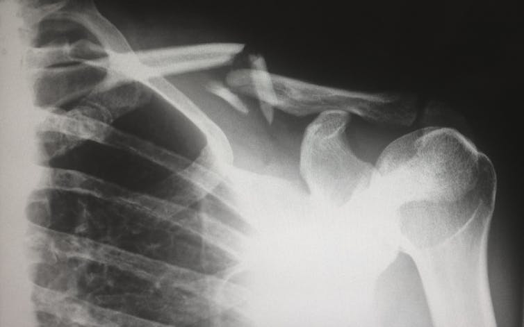 Radiografía de un tórax, varias costillas, hueso del hombro.