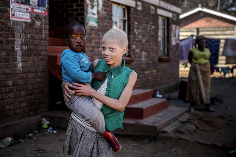 Albino girl carries a member of her family in Zimbabwe.