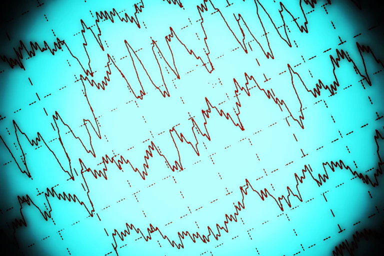 electroencefalograma.