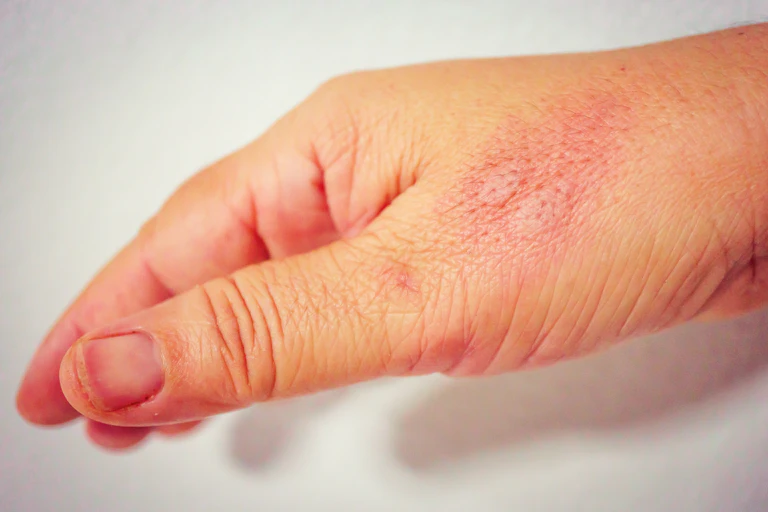 A hand with two raised, red bumps.