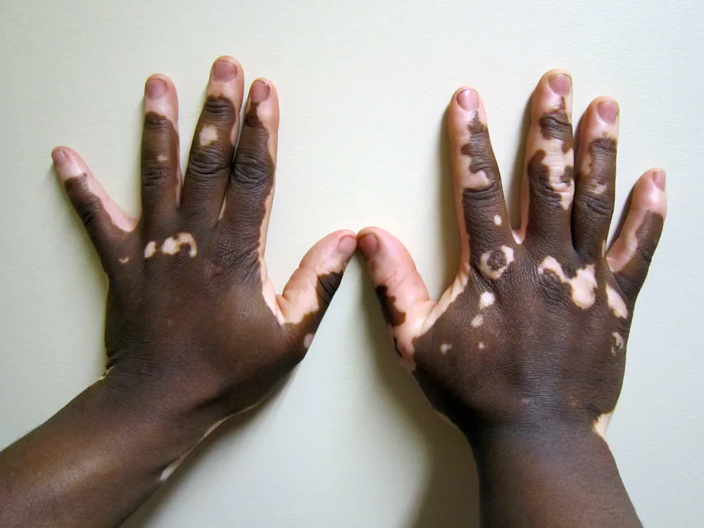 melanotic whitlow pictures Explainer: what is vitiligo?