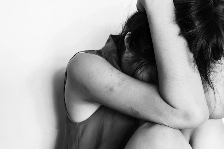 Woman with bruises with head in hands
