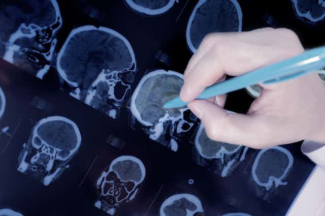 Una mano con bolígrafo azul señala un punto de un cerebro en una tomografía.