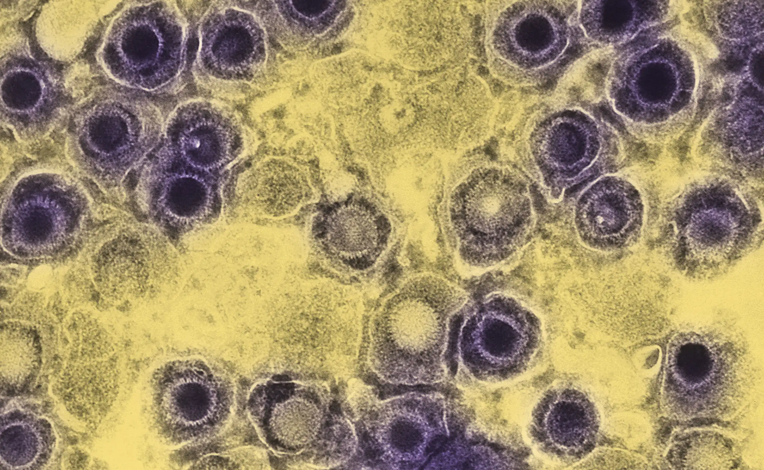 Negatively-stained transmission electron micrograph of numerous herpes simplex virions