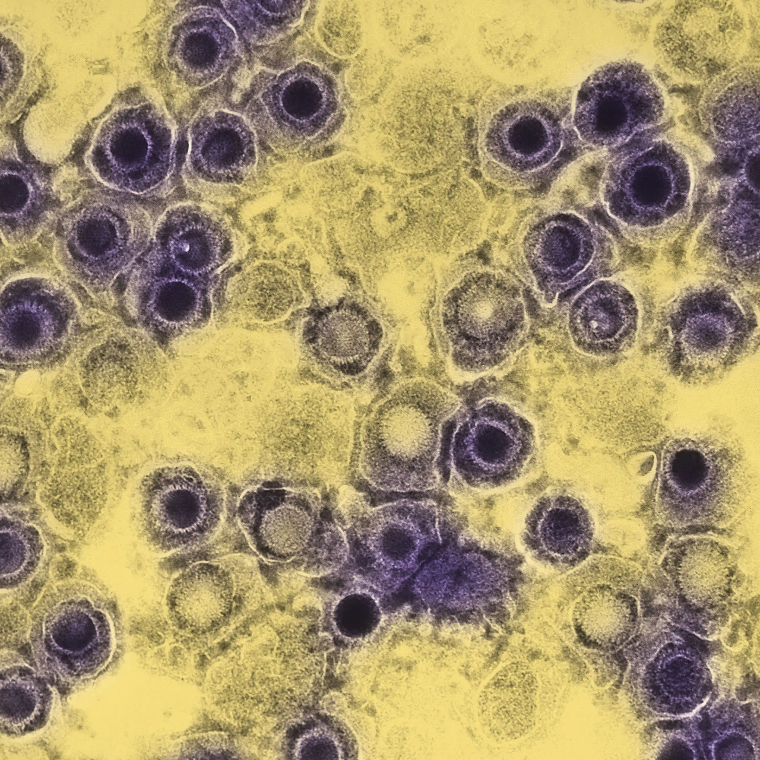 Negatively-stained transmission electron micrograph of numerous herpes simplex virions