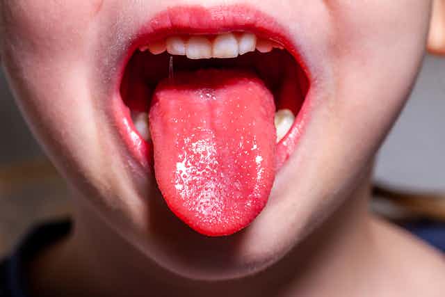 Scarlet fever outbreak in Scotland: what you need to know