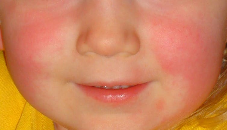 A child's face showing a scarlet fever rash.