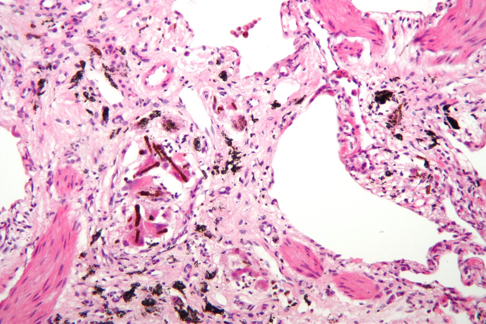 ¿Tienen los pacientes con asbestosis mayor riesgo de fallecer por covid? ¿Tienen los pacientes con asbestosis mayor riesgo de fallecer por covid?
