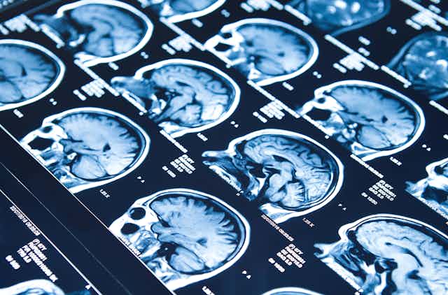 X-rays of the brain.