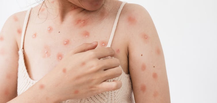 A monkeypox with monkeypox lesions on her arms and chest.