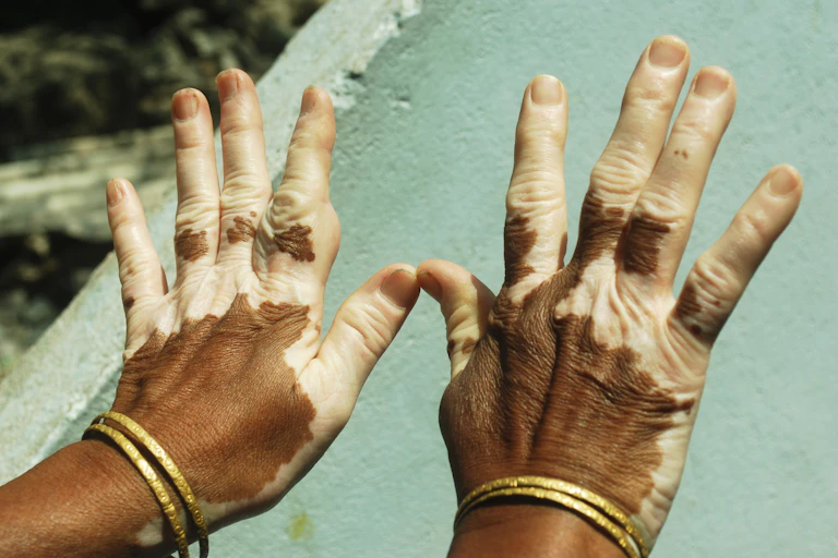 Vitiligo infected hands of a woman