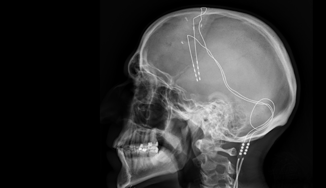 An x-ray showing wires in a person's brain.