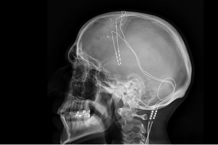 An x-ray showing wires in a person's brain.
