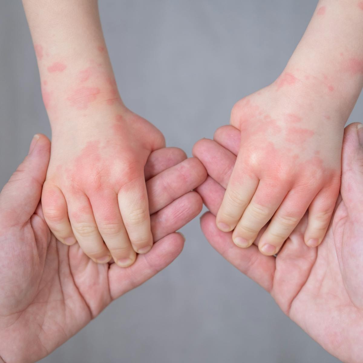 治未病-幾時傾養生-中醫保健-濕氣濕疹