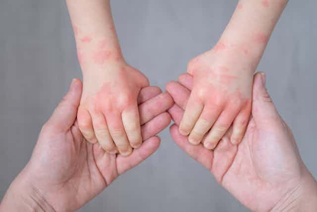 A child's hands covered in red blotches grasps an adult's hands.