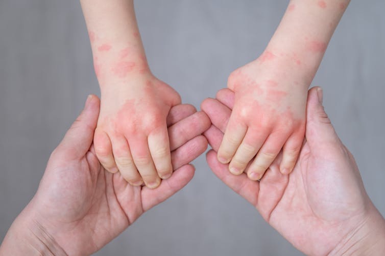 How to treat eczema and other skin conditions and when to see a doctor