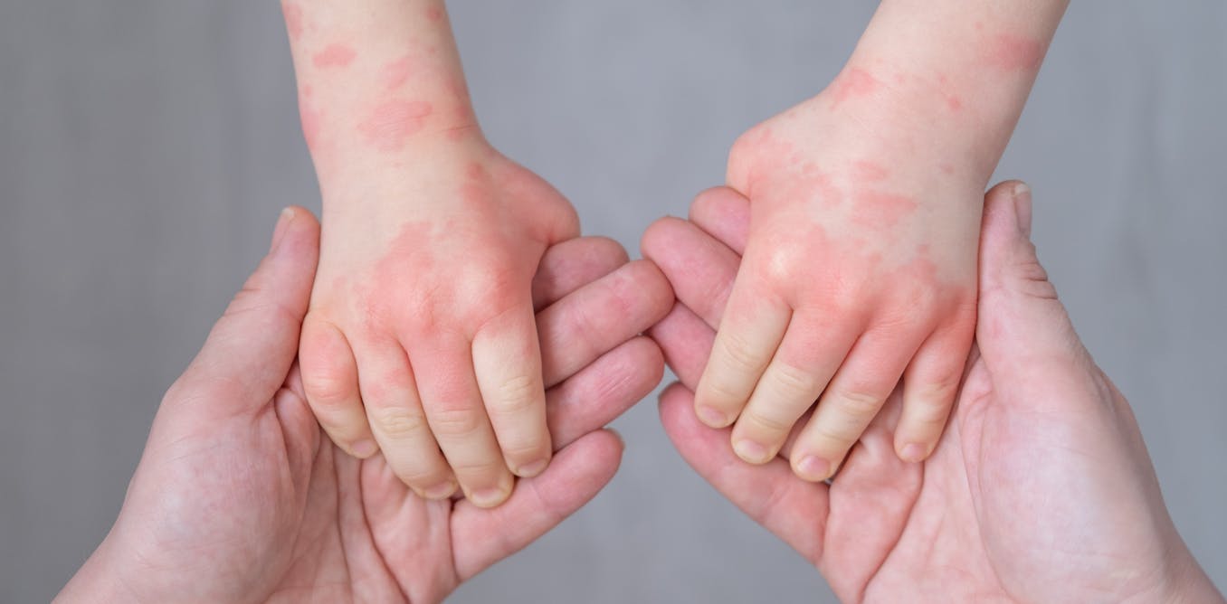 Cold weather brings itchy, irritated, dry and scaly skin – here’s how ...