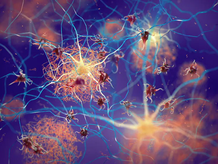 Clumps of amyloid forming on brain cells.