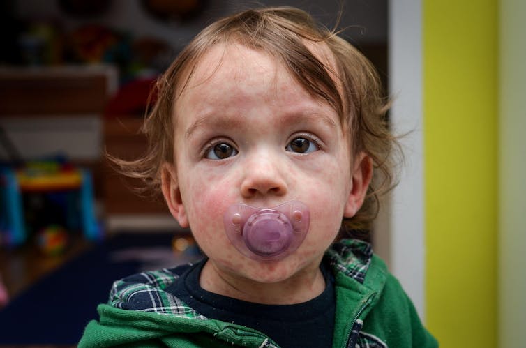 A child with a measles rash.