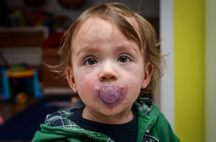 A child with a measles rash.